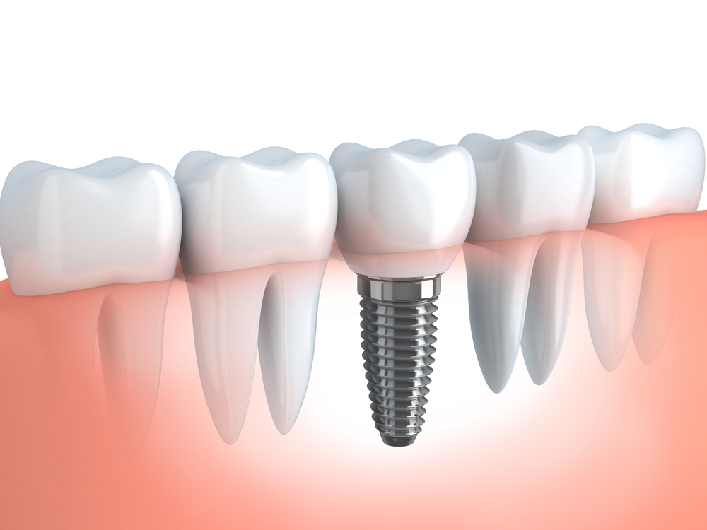 Recent Updates on Implant Research