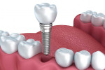 Dental implants - Latest Research and Changes