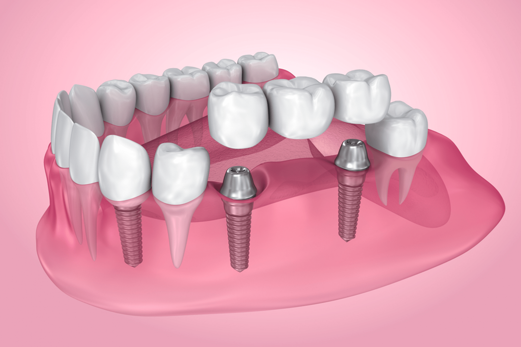 Latest Changes in Implant Dentistry
